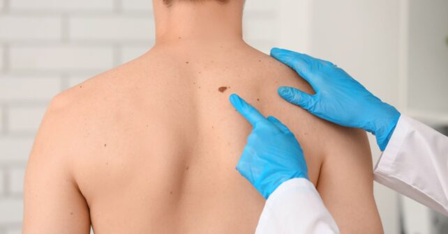 Dermatólogo examina lunar sospechoso en la espalda relacionado con riesgo de melanoma por cabinas de bronceado.