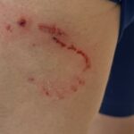 Terreur en plein jogging : mordu violemment par un chien, son témoignage choc
